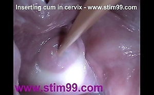 Interpolate semen cum in the matter of cervix fro dilatation pussy speculum